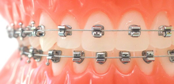 Brackets am Zahnmodell